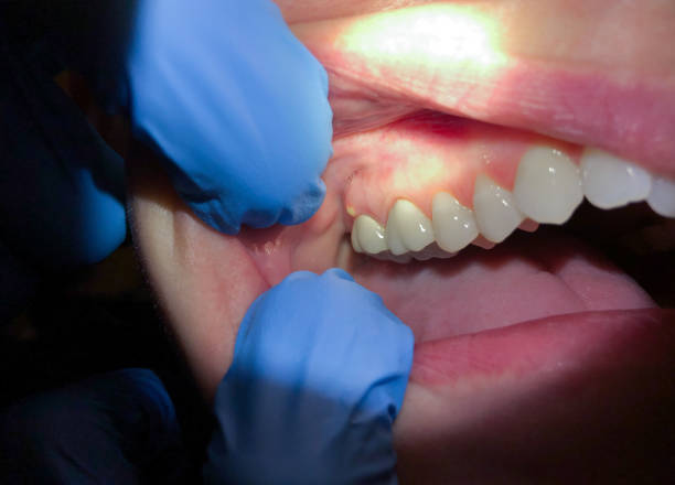 Teeth Whitening in WI